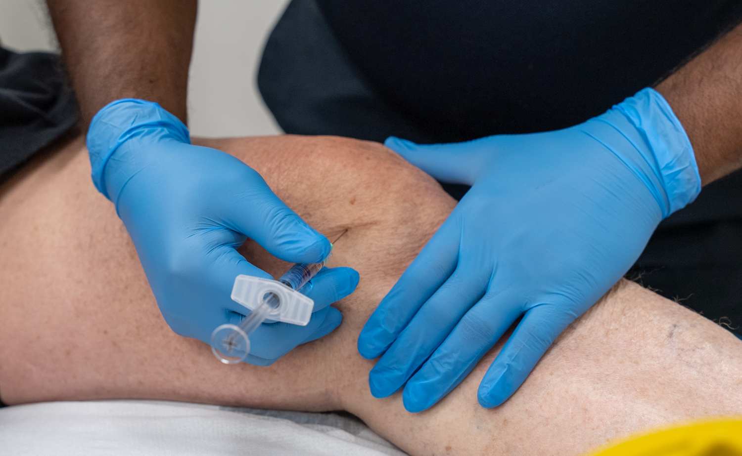 Arthrosamid Injection: A Long-Lasting, Non-Surgical Solution for Knee Osteoarthritis