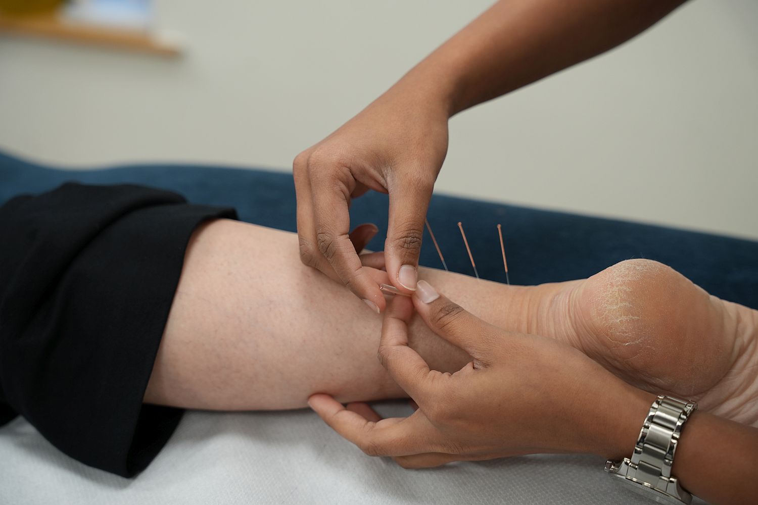 acupunture3
