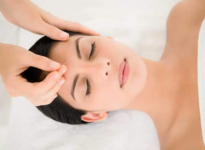 acupunture1